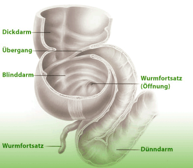 Blinddarm, Blinddarmentzündung