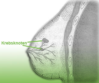 Brustknoten