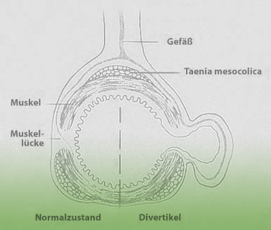 Divertikel