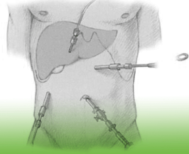 Gallen Operation