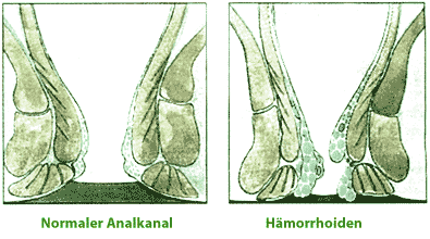 Verhinderung von Hämorrhoiden