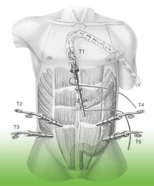 laparoskopische Operation Dickdarm