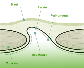 Nabel, Leistenbruch