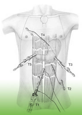 Antirefluxoperation