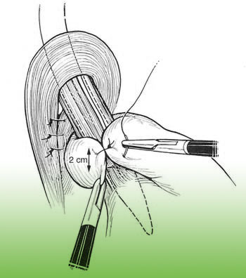 Reflux